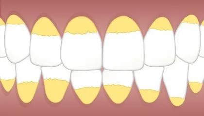 Hva er tannstein og hvordan behandler man det?