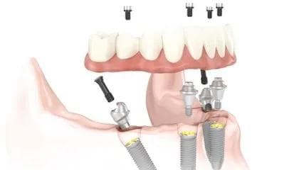 Nye faste tenner med All-on-4 og All-on-6
