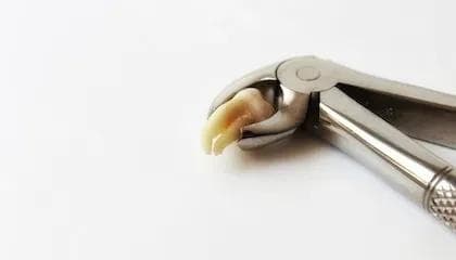 Å trekke visdomstann: Dette bør du vite