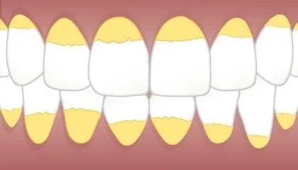 Hva kan jeg selv gjøre med tannstein?