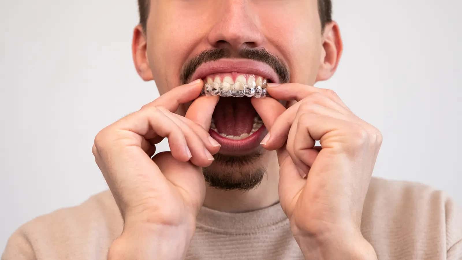 Invisalign – alt du må vite om usynlig tannregulering