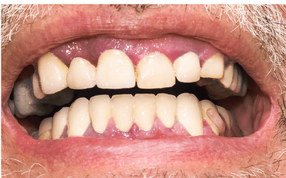 Alt du trenger å vite om gingivitt