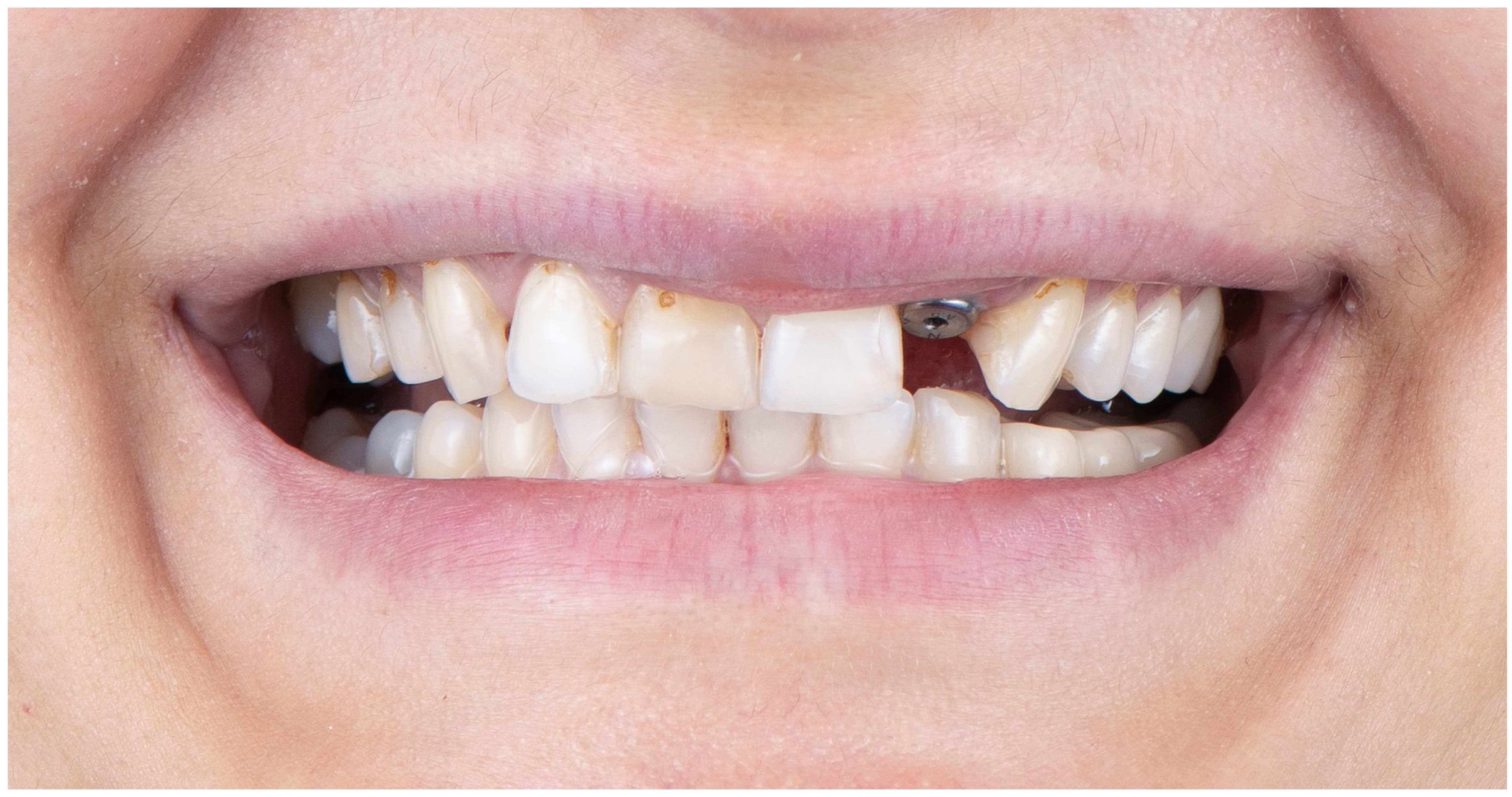 Hvordan kan tannimplantat redde kjevehelsen – og hva du bør gjøre