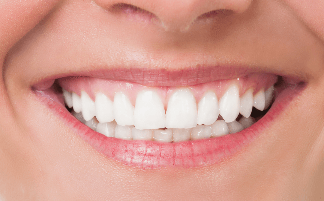 Tannbleking hos tannlegen er tryggere og mer effektivt