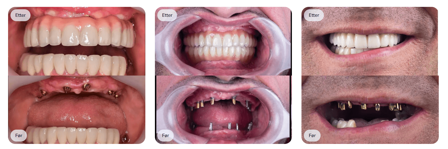 Før og Etter behandlingen med All-on-4/6