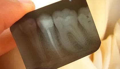 Hva er en rotfylling?