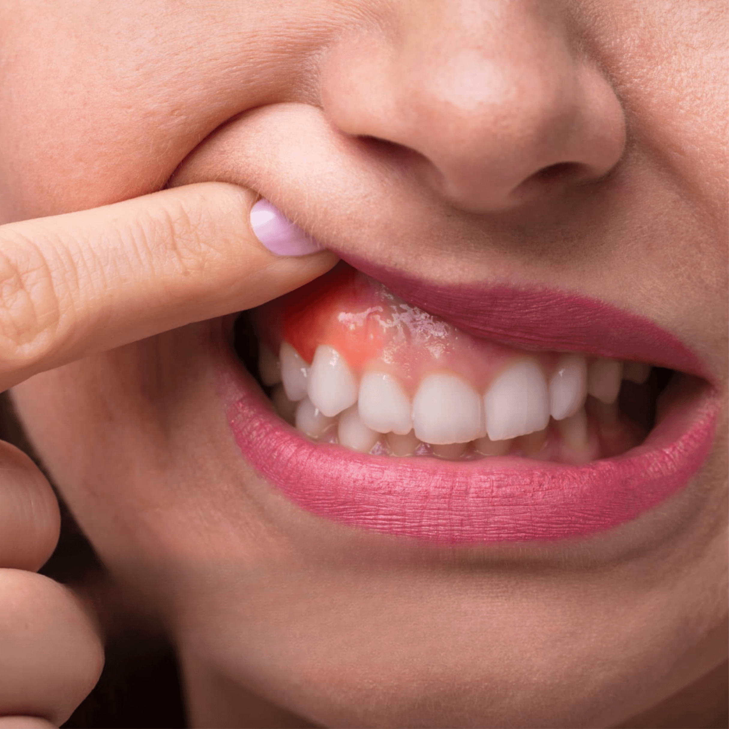 Hva er periodontitt?