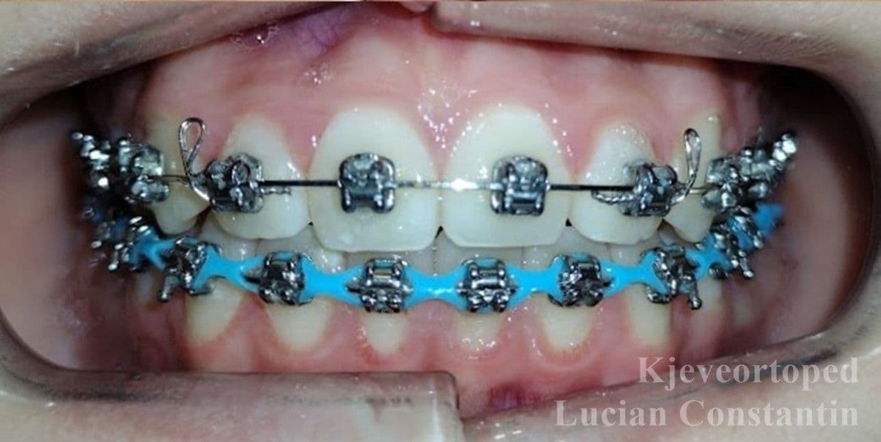 Hva koster tannregulering for voksne?