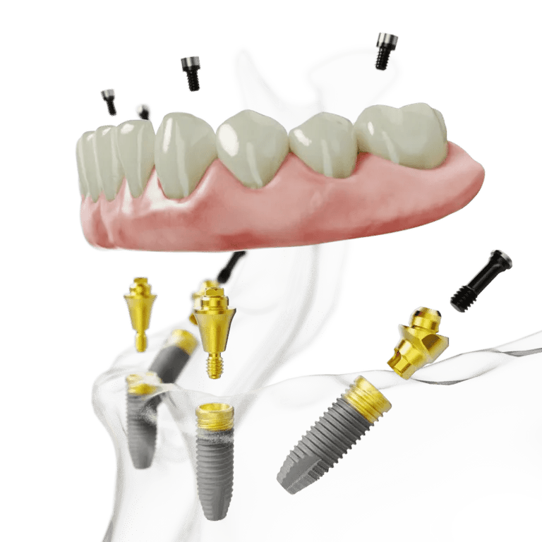 All-on-4 tannimplantater: Alt du trenger å vite