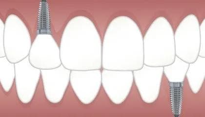 Hva betaler du for når du bestemmer deg for å skaffe deg tannimplantat?