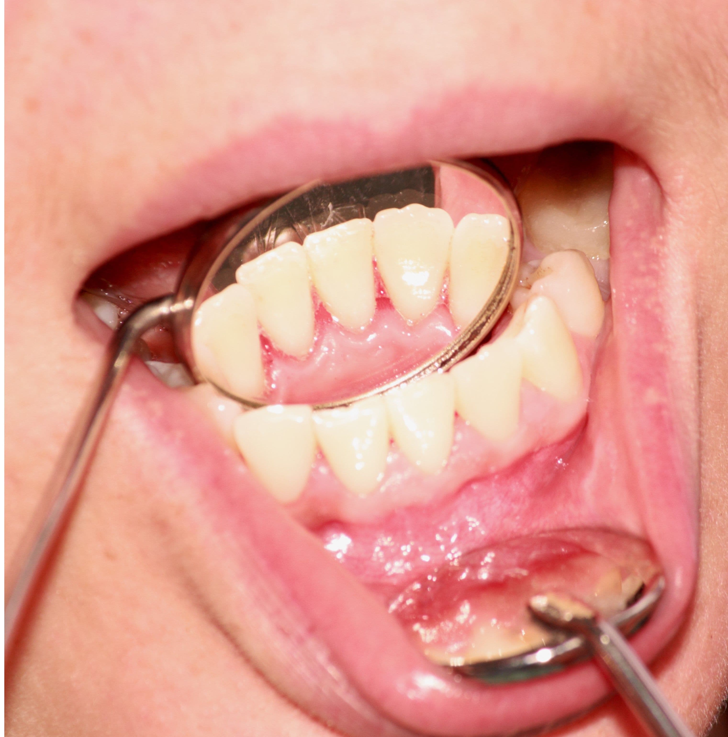 Hovent tannkjøtt rundt en tann