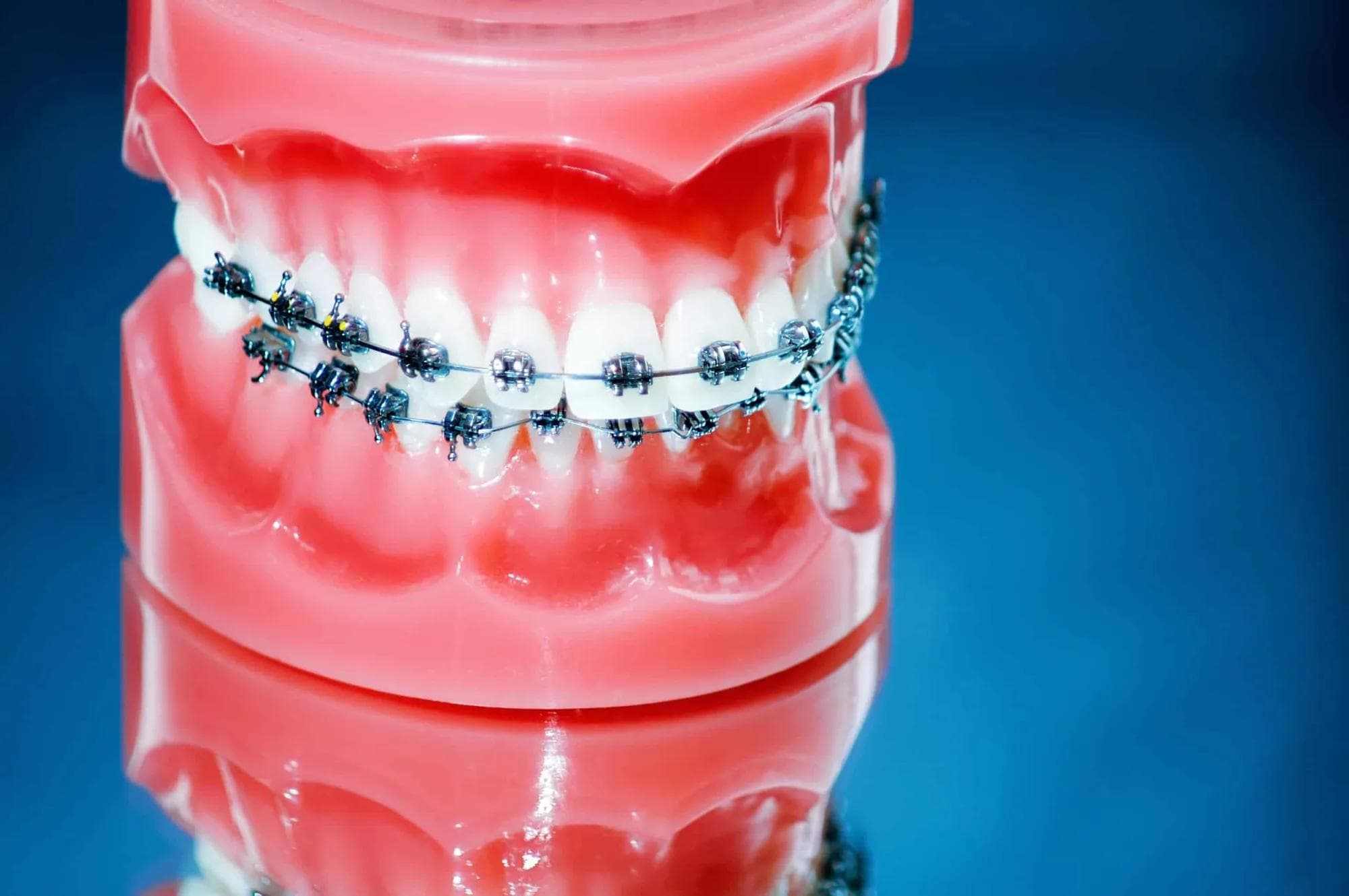 Skjevt smil? Tannstillingsfeil som overbitt bør ikke være et problem lenger!