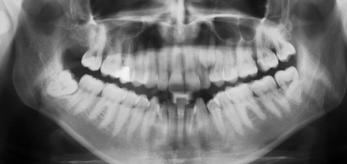 Gjør det vondt å trekke visdomstenner?