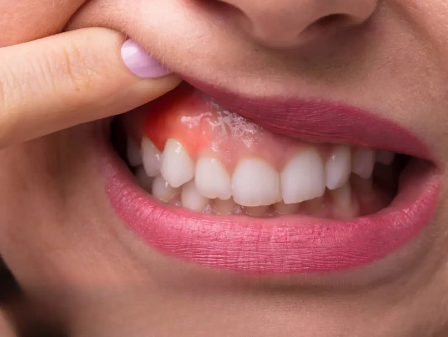 Tannkjøttbetennelse: Forebygging, symptomer og behandling