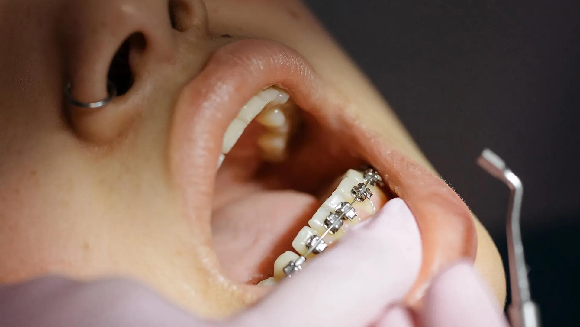 Kjeveortoped: Hva er en reguleringstannlege